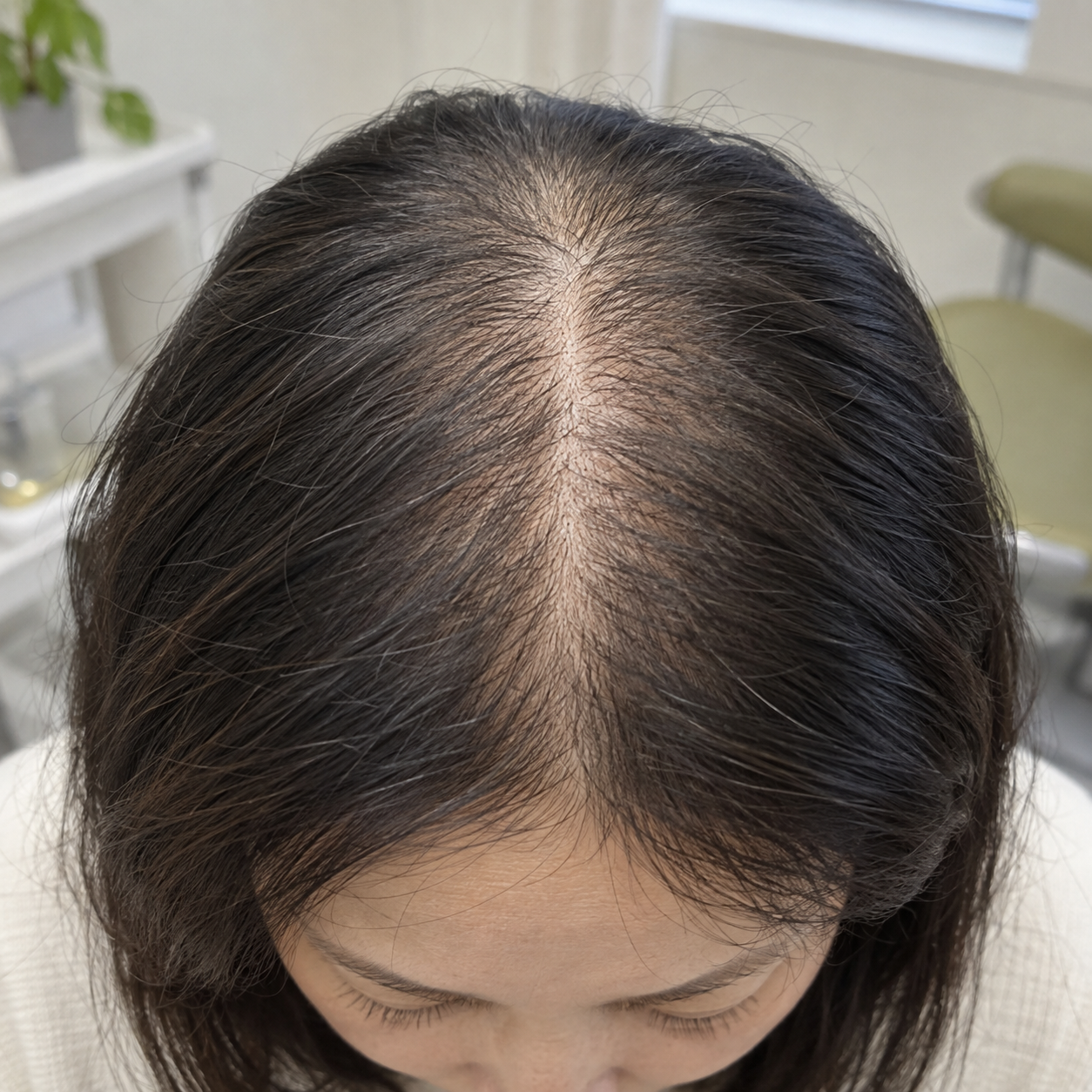 发缝变宽,头顶发量减少